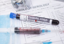 Etiópia potvrdzuje prvé smrteľné ohnisko vírusu Marburg